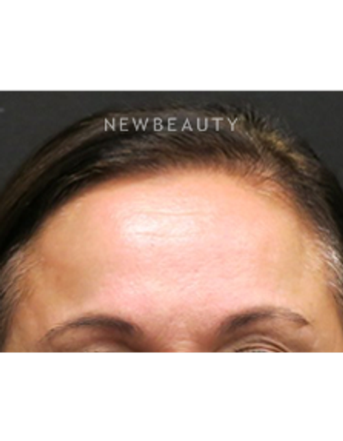Dr. Jody Levine - Lasers - After