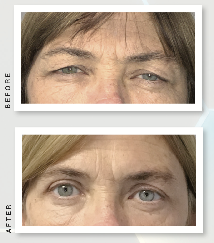 upper bleph before and after