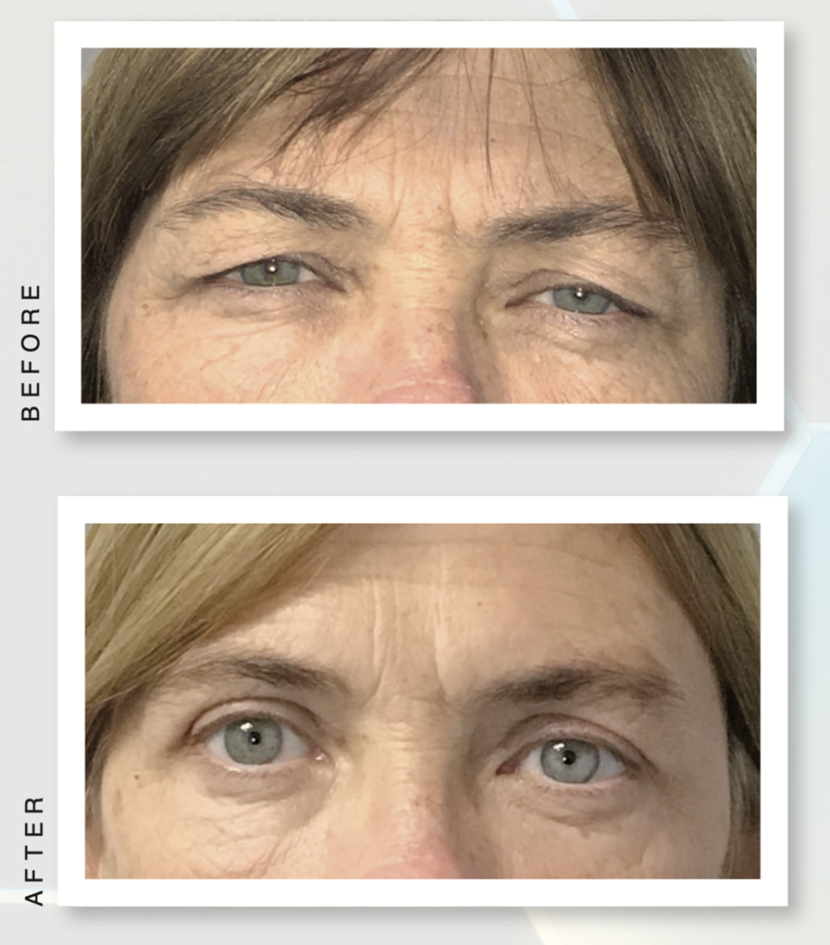 upper bleph before and after