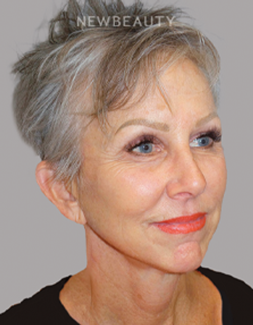 Dr. Sanjay Grover - Facelift - 49726567 - After
