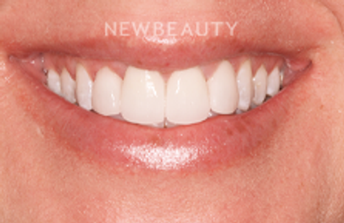 Dr. Joe Kravitz - Veneers - 44265252 - After