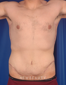 Dr. Peter Geldner Extended Abominoplasty with Side Resection - After