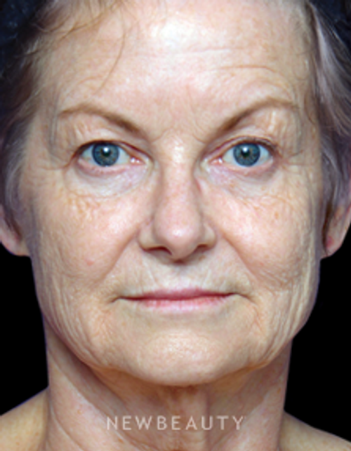 Dr. Alan Durkin - Upper Blepharoplasty - Before