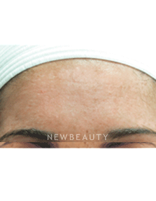 Dr. Jody Levine Lasers, Chemical Peel - After