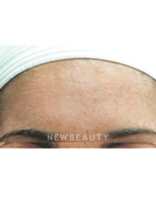 Dr. Jody Levine Lasers, Chemical Peel - After
