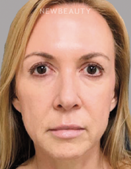 Dr. Janine Hopkins - “Liquid Facelift” - After