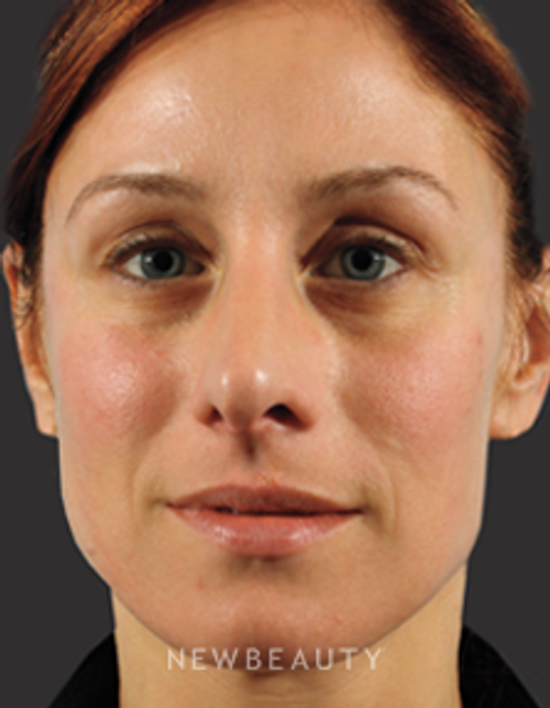 Dr. Marina Peredo Injectables & Fillers - After