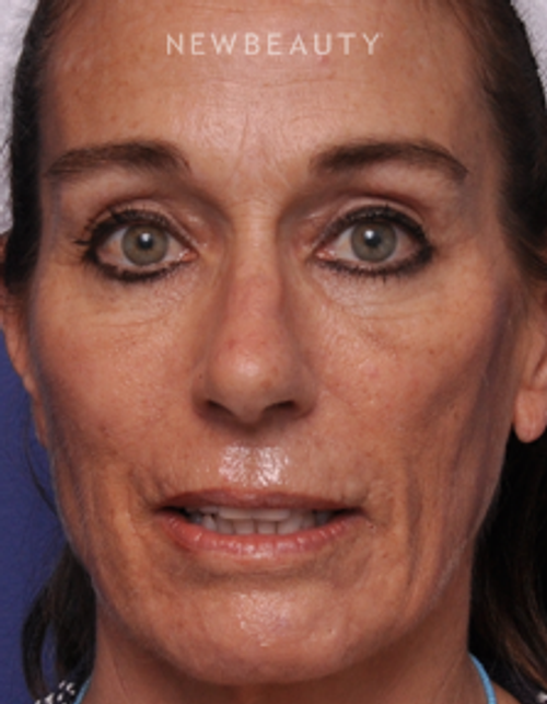 Dr. Alan J. Durkin - Eyelift - After