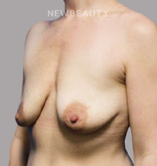 Dr. Teri Moak - Restoring Volume - 45241488 - Before