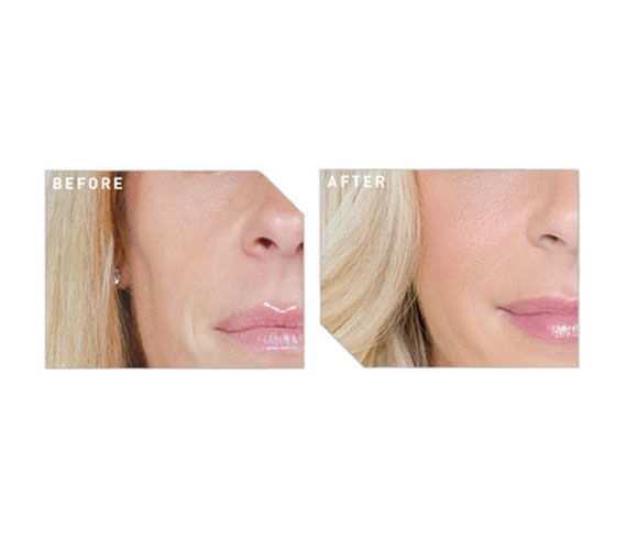 Before and After cheek filler