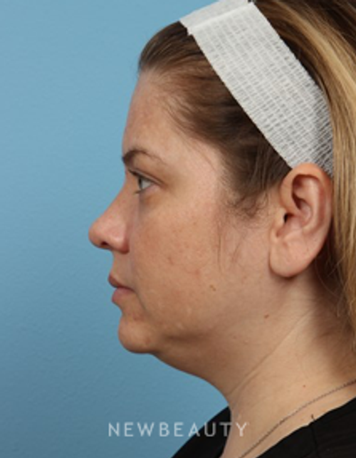 Dr. Kathleen L. Behr - Kybella - Before