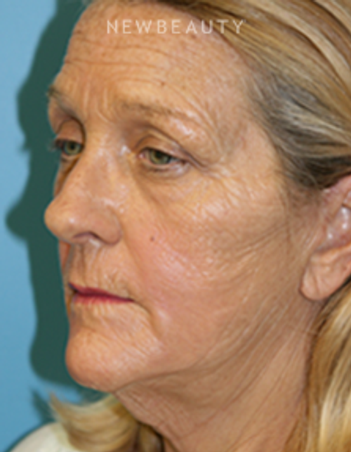 Dr. Christine Hamori - Full Facelift - After