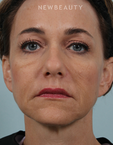 Dr. Kenneth Beer - Liquid Facelift - After