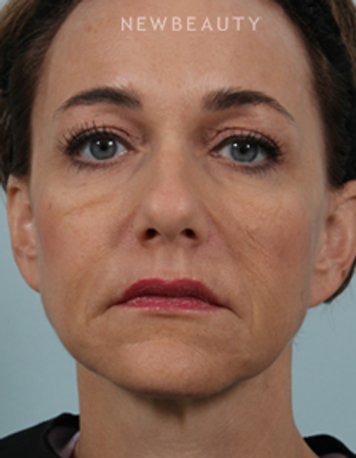 Dr. Kenneth Beer - Liquid Facelift - After
