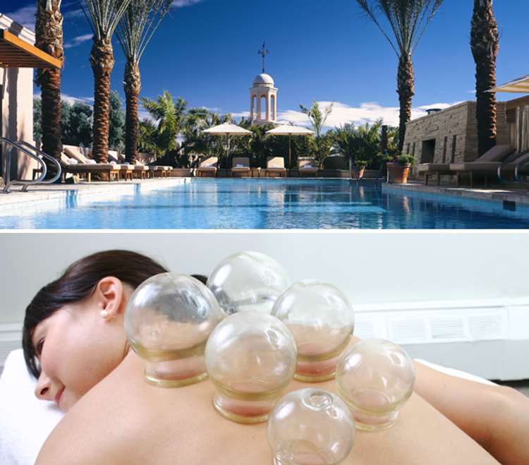 Cupping
