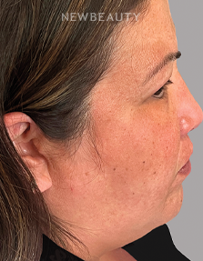 Dr. Husam Almunajed – Smile Makeover - 32902668 - After