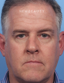 Dr. Kelly Bomer - Browlift - Before