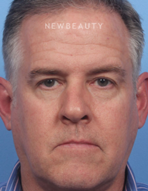 Dr. Kelly Bomer - Browlift - Before