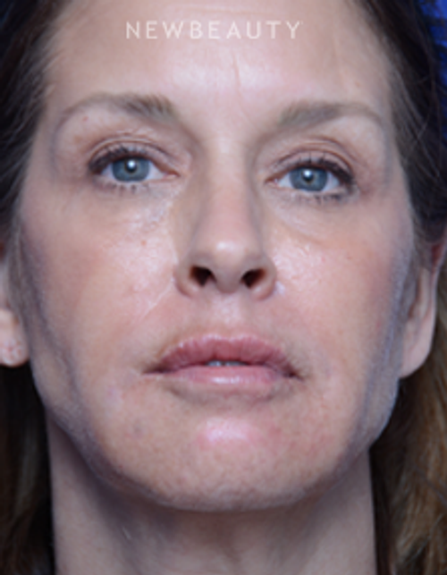 Dr. Alan Durkin - Facelift - After