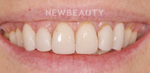 Dr. Salvator La Mastra - Smile Makeover -46106673 - Before