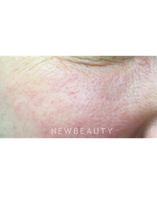 Dr. Kally Papantoniou - KTP Laser Treatment - After
