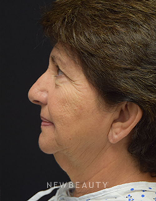 Dr. Jeffrey B. Wise - Eyelift, Facelift & Lasers - Before