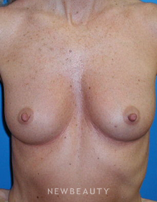 Dr. George Sanders Breast Implants - Before