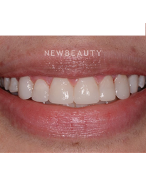 Dr. Irene Grafman - Dental Bonging - After