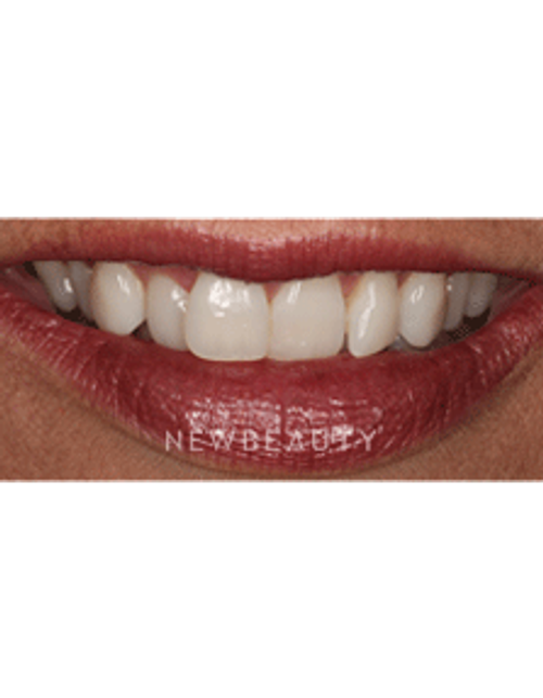 Dr. Neal Patel Braces - Before