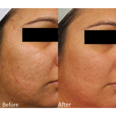 Microneedling before and after Image / Kathleen Behr
