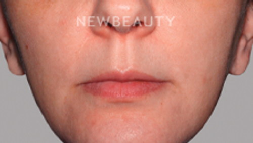 Dr. Elaine Kung - Skin Tone and Rosacea - 33036743 - After