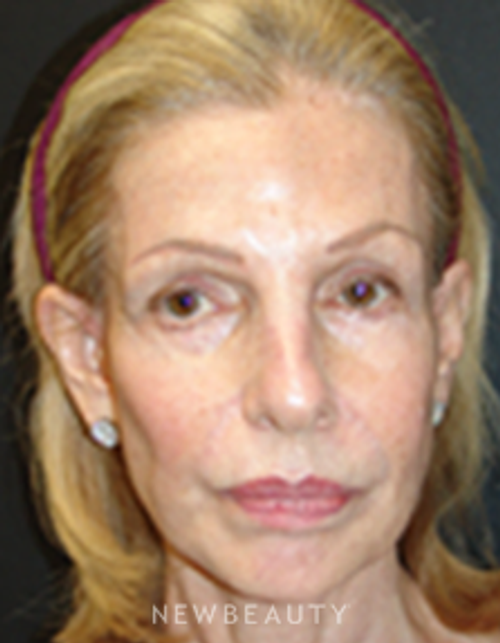 Dr. Mokhtar Asaadi Facelift, Necklift - Before