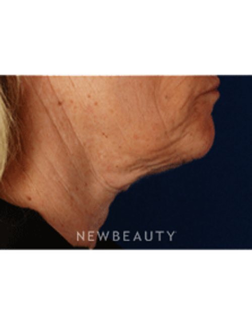 Dr. Gilly Munavalli Liposuction - After