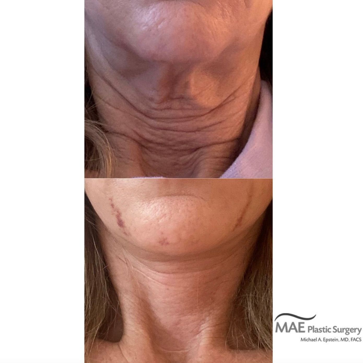 A necklift will get rid of excess skin and restore youthful contours.