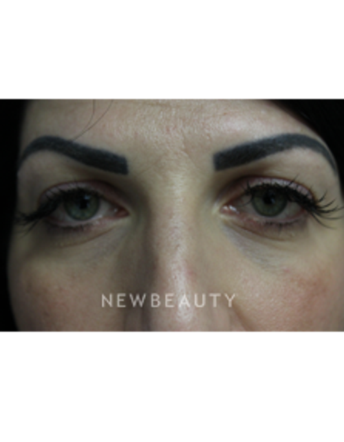 Dr. Joseph Russo - Youthful Look (Eye EBG) - Before