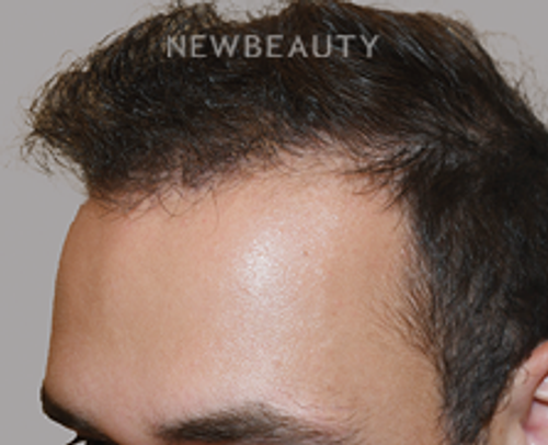 Dr. Jeffrey Epstein - Hair Transplant - 46167841 - After