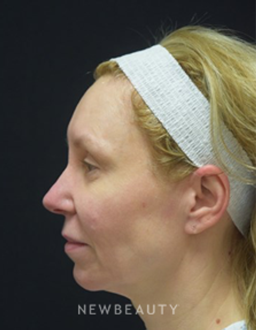 Dr. Jeffrey B. Wise - Facelift - Before