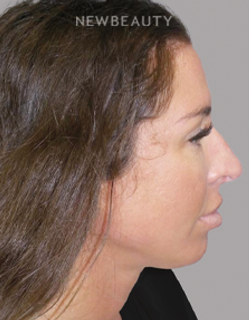 Dr. Sanjay Grover - Rhinoplasty - 49727947 - Before