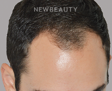 Dr. Anthony Bared - Hair Transplant - 46164621 - Before