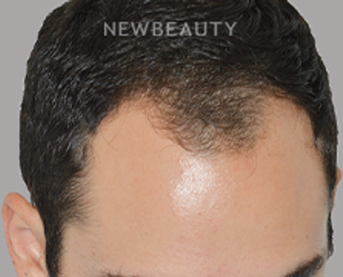 Dr. Anthony Bared - Hair Transplant - 46164621 - Before