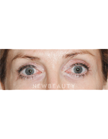 Dr. Lee Ann Klausner Blepharoplasty - After