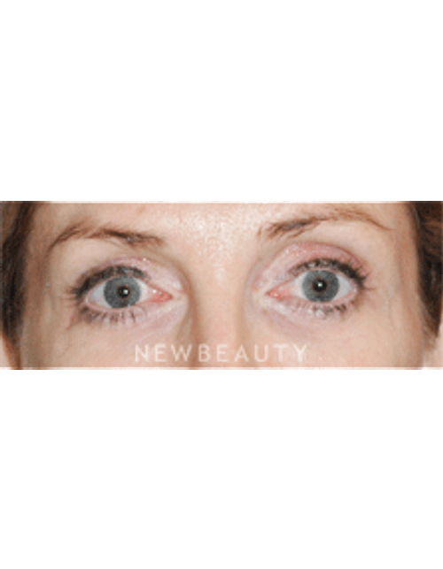 Dr. Lee Ann Klausner Blepharoplasty - After