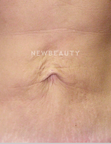 Dr. Ruth Hillelson Skin Resurfacing - Before