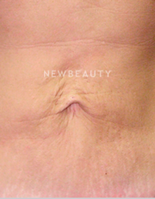 Dr. Ruth Hillelson Skin Resurfacing - Before