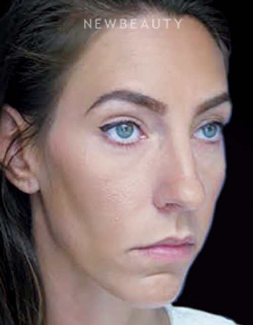 Dr. Joseph Russo - Under-Eye Rejuvenation - After