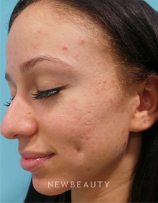 Dr. Sean Simon - Fresh and Clear Skin - Before