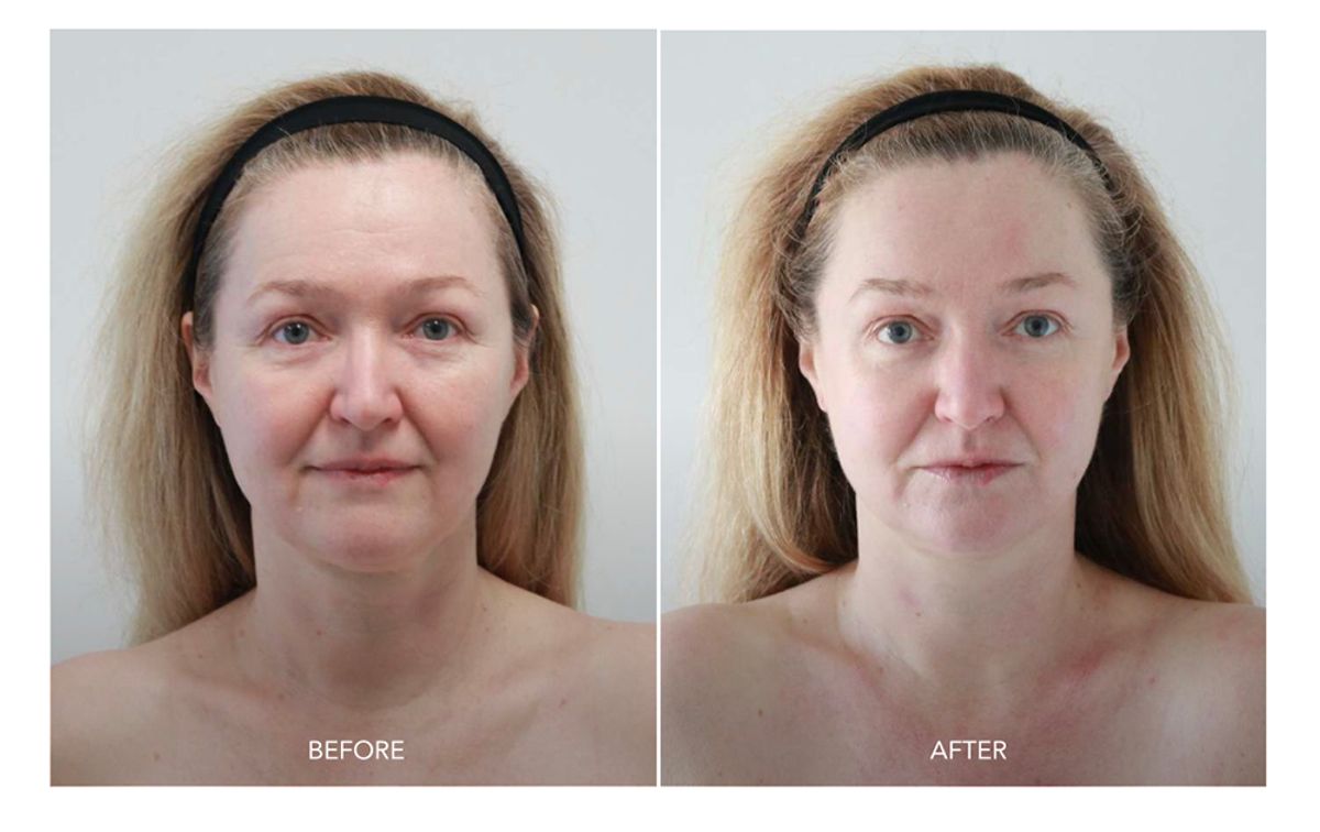 SKORR GLOW BEORE AND AFTER