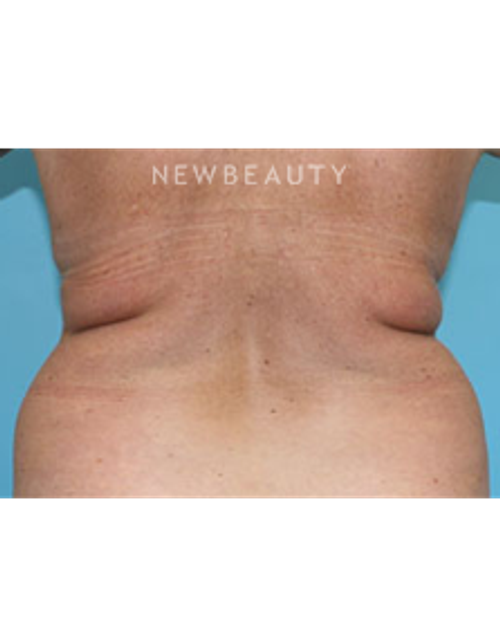 Dr. Christine Hamori - Tummy Tuck - Before