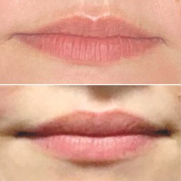 lip flip before and after using Botox to lift the Cupid's bow