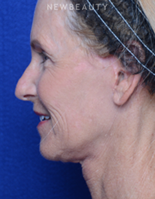 Dr. Alan Durkin - Facelift - After